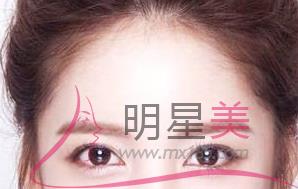 推顴骨有什么后遺癥嗎