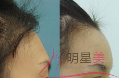 硫磺皂洗臉的好處