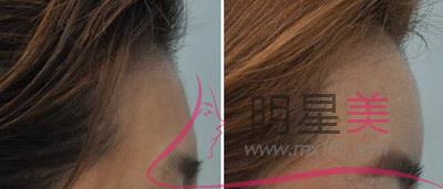 整<a href=http://m.f3bb6.cn/listinfo-629-0.html target=_blank class=infotextkey>下頜角</a>和顴骨