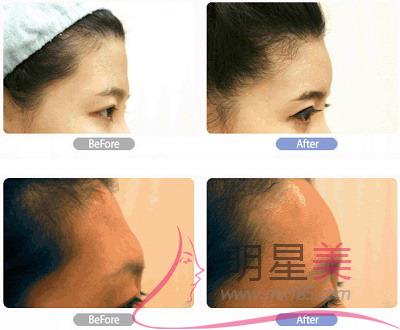 額頭<a href=http://m.f3bb6.cn/listinfo-754-0.html target=_blank class=infotextkey>鼻翼</a>兩側下巴長痘痘什么原因啊