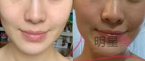 額頭挨著頭皮長痘痘