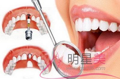 拔牙為什么會臉腫