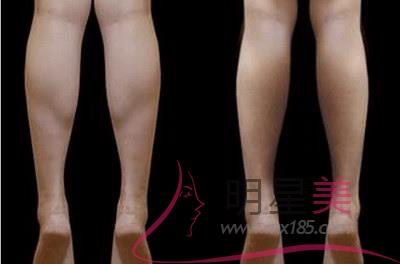 大腿抽脂小腿腫脹時間詳解