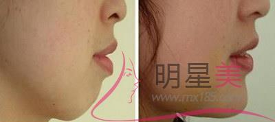 新生高額頭植發