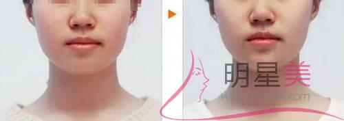 人造酒窩好看么