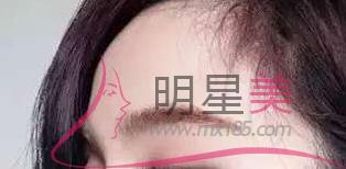 填充<a href=http://m.f3bb6.cn/listinfo-722-0.html target=_blank class=infotextkey>臥蠶</a>可以用<a href=http://m.f3bb6.cn/listinfo-731-0.html target=_blank class=infotextkey>玻尿酸</a>嗎