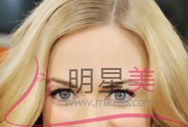 <a href=http://m.f3bb6.cn/listinfo-690-0.html target=_blank class=infotextkey>自體脂肪填充</a>額頭腫脹期多久