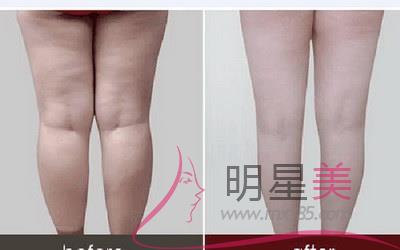 怎么減腿上的肥肉