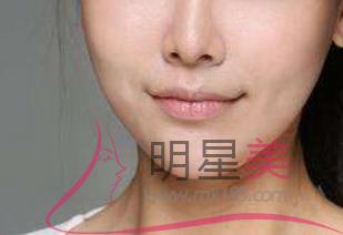 怎么修復下巴長痘