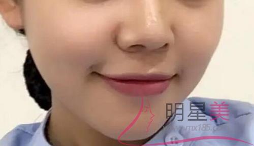 如何讓太陽穴變飽滿