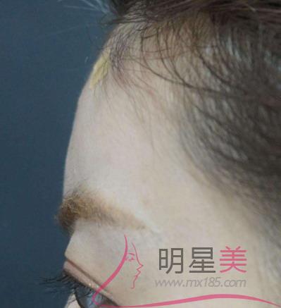 墊下巴怎么取出來的