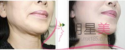 墊下巴怎么選材料