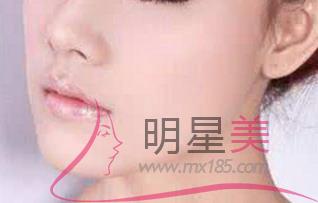 藥水雀斑可以徹底祛除嗎