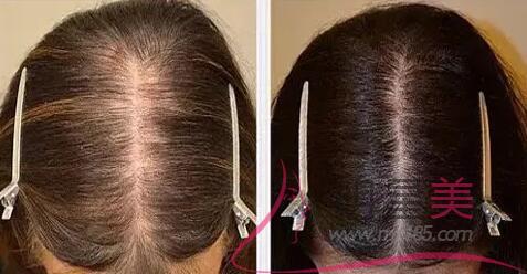 晚睡和脫發有關系嗎