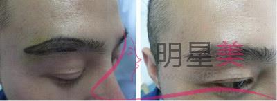 紋眉多久可以懷孕最好