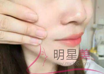 顴骨突出的原因