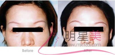 帶隱形牙套臉頰凹陷