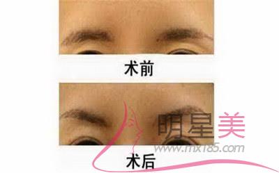 撫州<a href=http://m.f3bb6.cn/listinfo-652-0.html target=_blank class=infotextkey>眉毛種植</a>毛種植