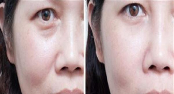 做E光<a href=http://m.f3bb6.cn/listinfo-792-0.html target=_blank class=infotextkey>去法令紋</a>有副作用嗎