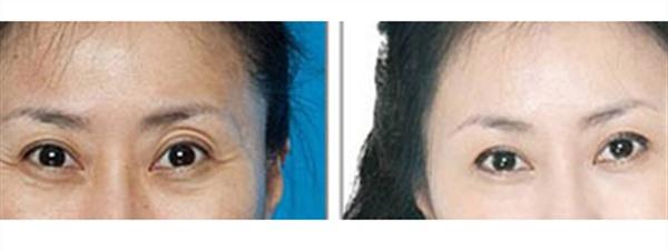 激光除魚尾紋不適用人群有哪些？