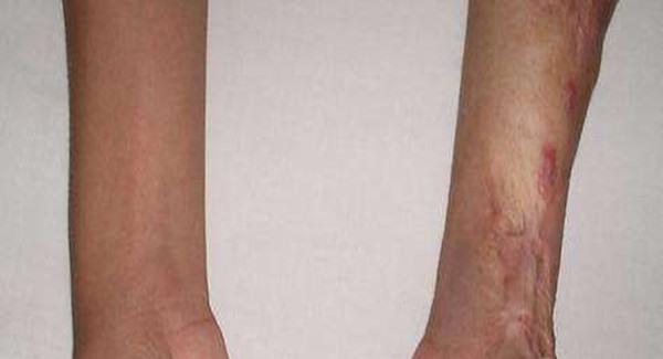 做燙傷疤痕修復手術時間是多久？