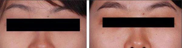 做切除手術<a href=http://m.f3bb6.cn/listinfo-788-0.html target=_blank class=infotextkey>去黑痣</a>風險有哪些