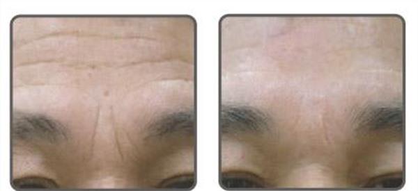 做自體脂肪<a href=http://m.f3bb6.cn/listinfo-771-0.html target=_blank class=infotextkey>去眉間紋</a>風(fēng)險有哪些