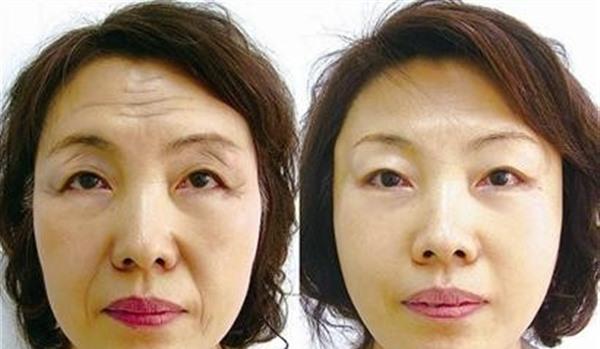 做<a href=http://m.f3bb6.cn/listinfo-613-0.html target=_blank class=infotextkey>射頻</a><a href=http://m.f3bb6.cn/listinfo-765-0.html target=_blank class=infotextkey>去抬頭紋</a>效果好不好