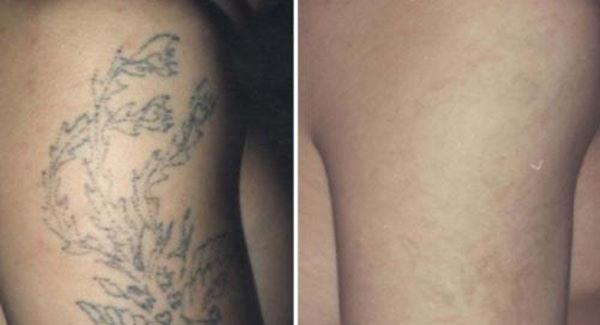 做<a href=http://m.f3bb6.cn/listinfo-793-0.html target=_blank class=infotextkey>洗紋身</a>副作用