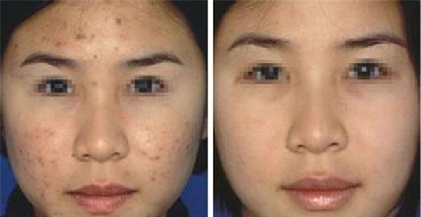 做膠原蛋白填充<a href=http://m.f3bb6.cn/listinfo-797-0.html target=_blank class=infotextkey>去痘疤</a>副作用是什么