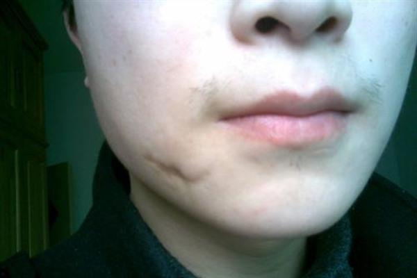 切除縫合治療痘疤手術缺點有哪些？