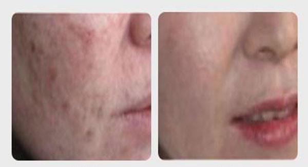 做<a href=http://m.f3bb6.cn/listinfo-734-0.html target=_blank class=infotextkey>愛貝芙</a><a href=http://m.f3bb6.cn/listinfo-797-0.html target=_blank class=infotextkey>去痘疤</a>價格貴嗎