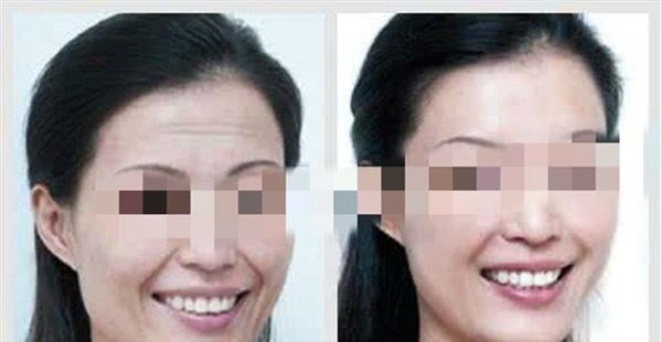 做自體脂肪<a href=http://m.f3bb6.cn/listinfo-765-0.html target=_blank class=infotextkey>去抬頭紋</a>費用多少錢