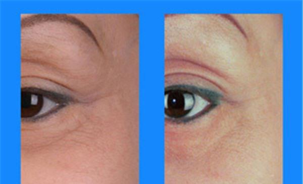 做果酸換膚<a href=http://m.f3bb6.cn/listinfo-782-0.html target=_blank class=infotextkey>去眼角細紋</a>價格