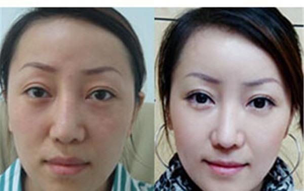 做紅藍光美膚價格