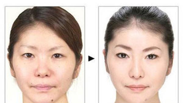 做光子點痣價格