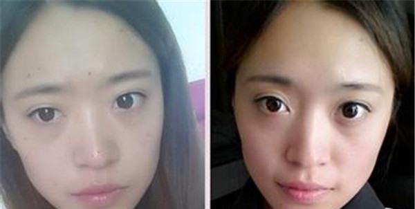 做手術去痣價格