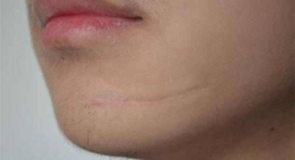 做面部疤痕修復手術注意事項是什么？