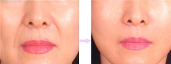 自體脂肪<a href=http://m.f3bb6.cn/listinfo-792-0.html target=_blank class=infotextkey>去法令紋</a>有副作用嗎？