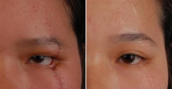 做面部疤痕修復多少錢