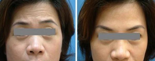 E光除抬頭紋手術注意事項是什么?