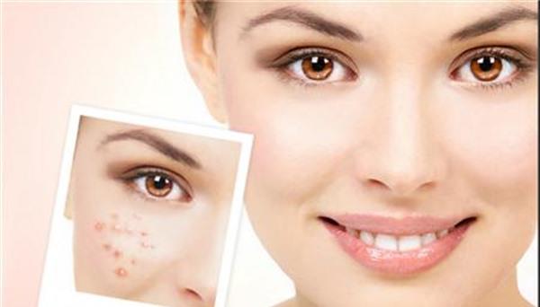 做激光去痘印手術多少錢？