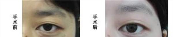 <a href=http://m.f3bb6.cn/listinfo-799-0.html target=_blank class=infotextkey>去太田痣</a>手術注意事項是什么？