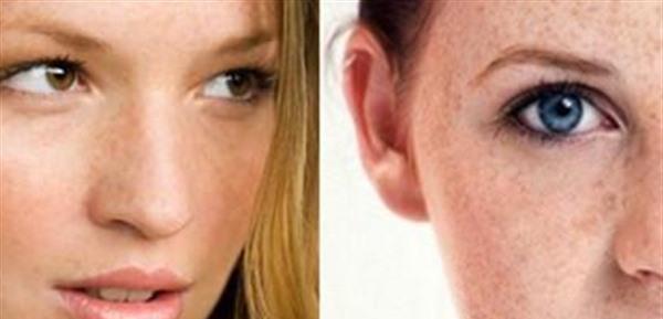 黃褐斑是什么引起的