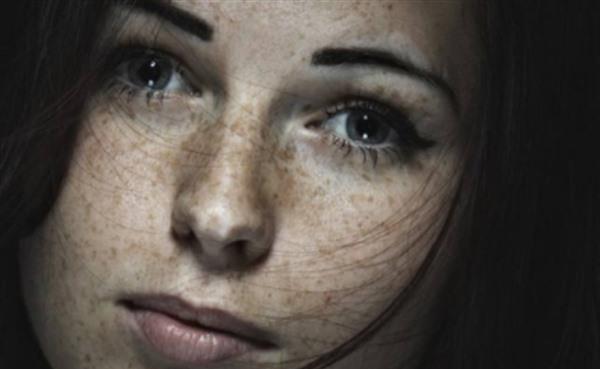 雀斑治療費(fèi)用