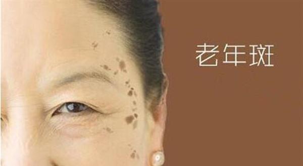 臉上長老年斑是什么原因
