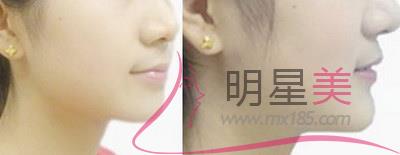 抽脂<a href=http://m.f3bb6.cn/listinfo-630-0.html target=_blank class=infotextkey>豐太陽穴</a>多久才能側(cè)著睡