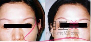 抽脂<a href=http://m.f3bb6.cn/listinfo-630-0.html target=_blank class=infotextkey>豐太陽穴</a>安全嗎