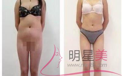 常熟去哪兒<a href=http://m.f3bb6.cn/listinfo-682-0.html target=_blank class=infotextkey>溶脂</a>好