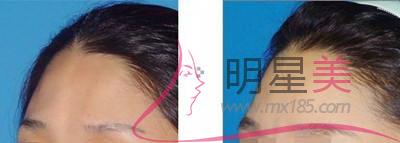 深圳臉部整容多少錢